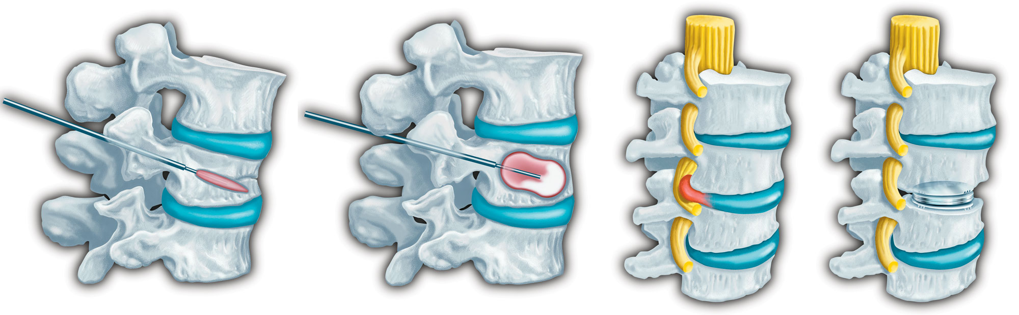 Spine medical illustration